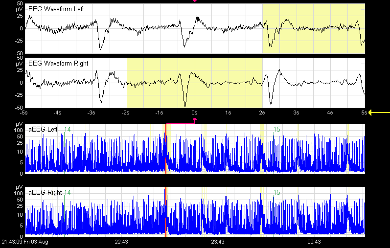 Screen shot showing EEG L/R waveforms with corresponding amplitude integrated electroencephalography (aEEG).