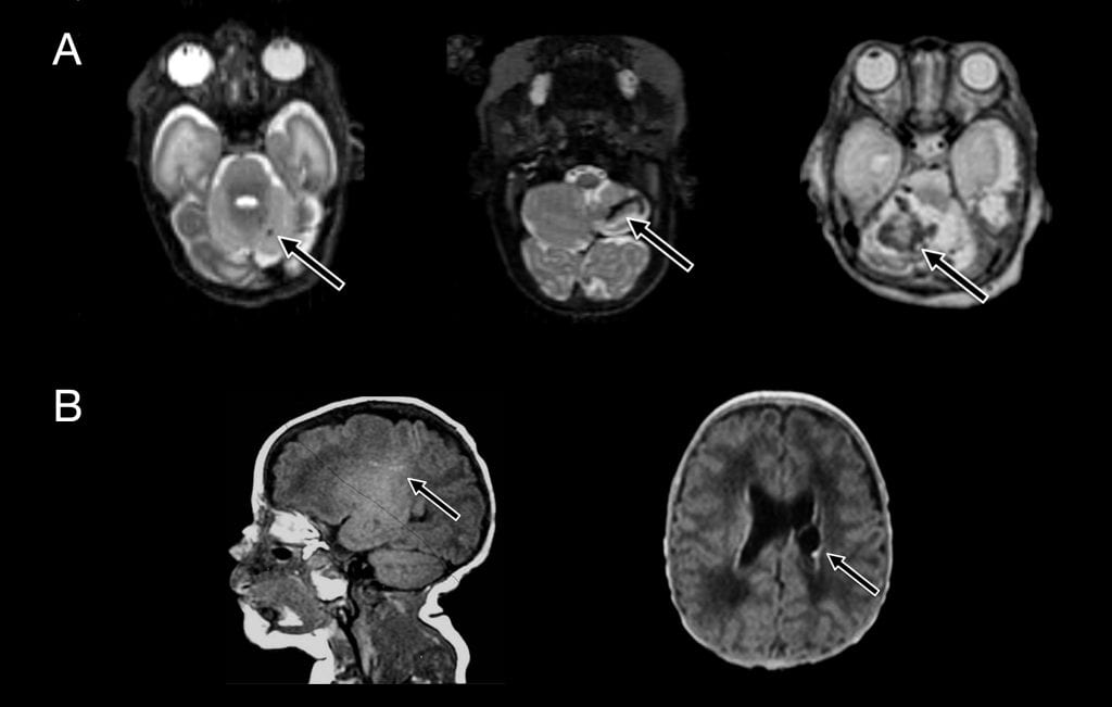 Cerebellar hemorrhage examples are shown on T2 sequences in (A): punctate injury is shown in the left column, small in the middle, and large in the right column. White matter injury examples are shown on T1 sequences in (B): punctate injury is shown at the left, while a cystic lesion is shown on the right. The primary focus of the injury is shown by the arrow.