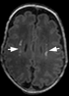MRI image with periventricular leukomalacia indicated by arrows