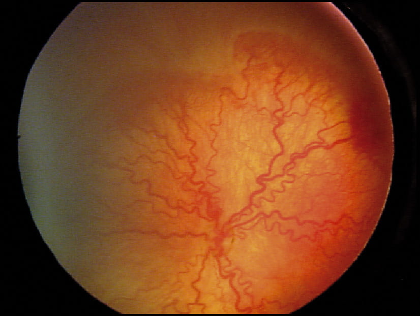Photo of retina with retinopathy 